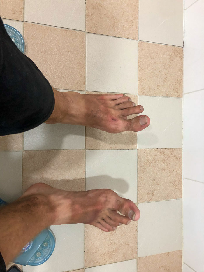 My burned feet from 8 days on the scooter.